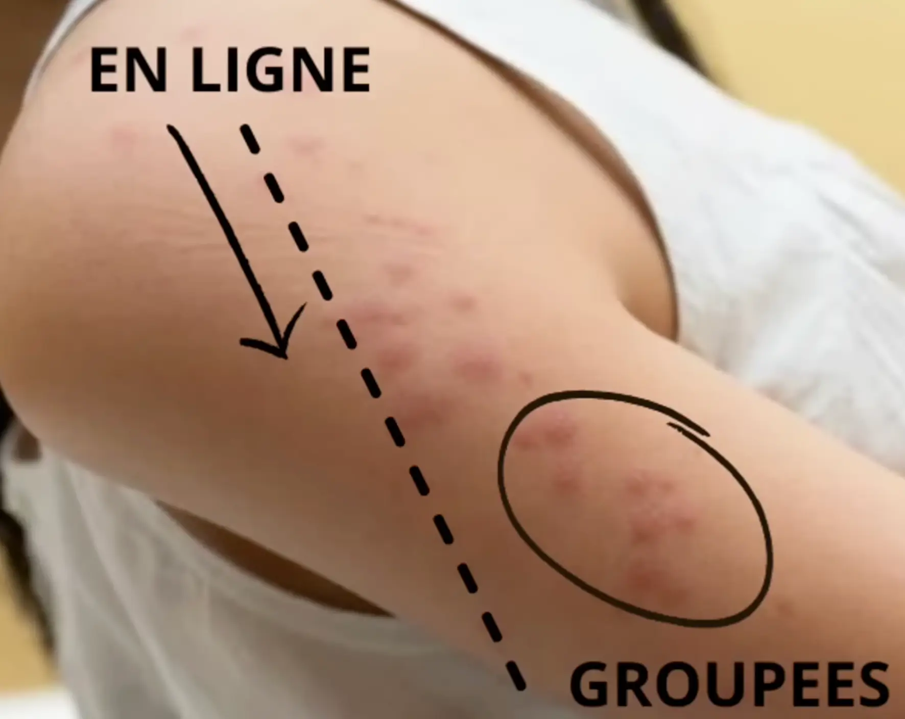 Reconnaitre des piqûres de punaise de lit