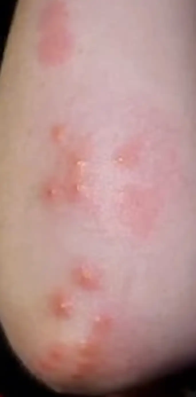 piqûre de punaise de lit qui s'infecte