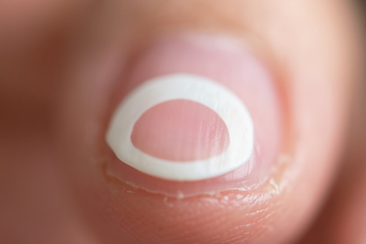 Lunule des ongles : absence, signification et signes d&rsquo;alerte