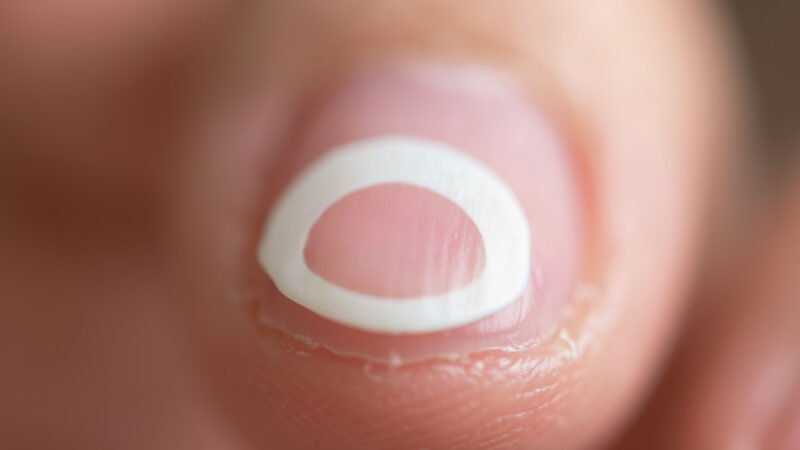 Lunule des ongles : absence, signification et signes d&rsquo;alerte