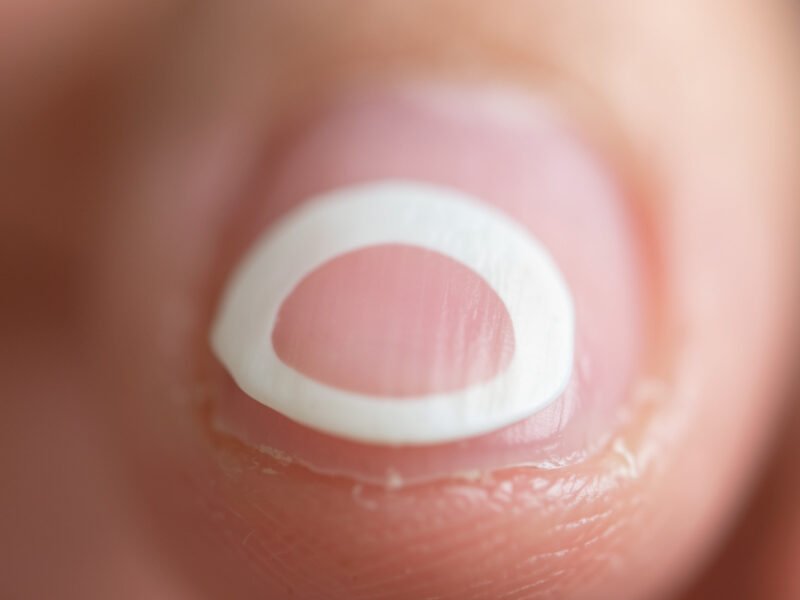 Lunule des ongles : absence, signification et signes d’alerte