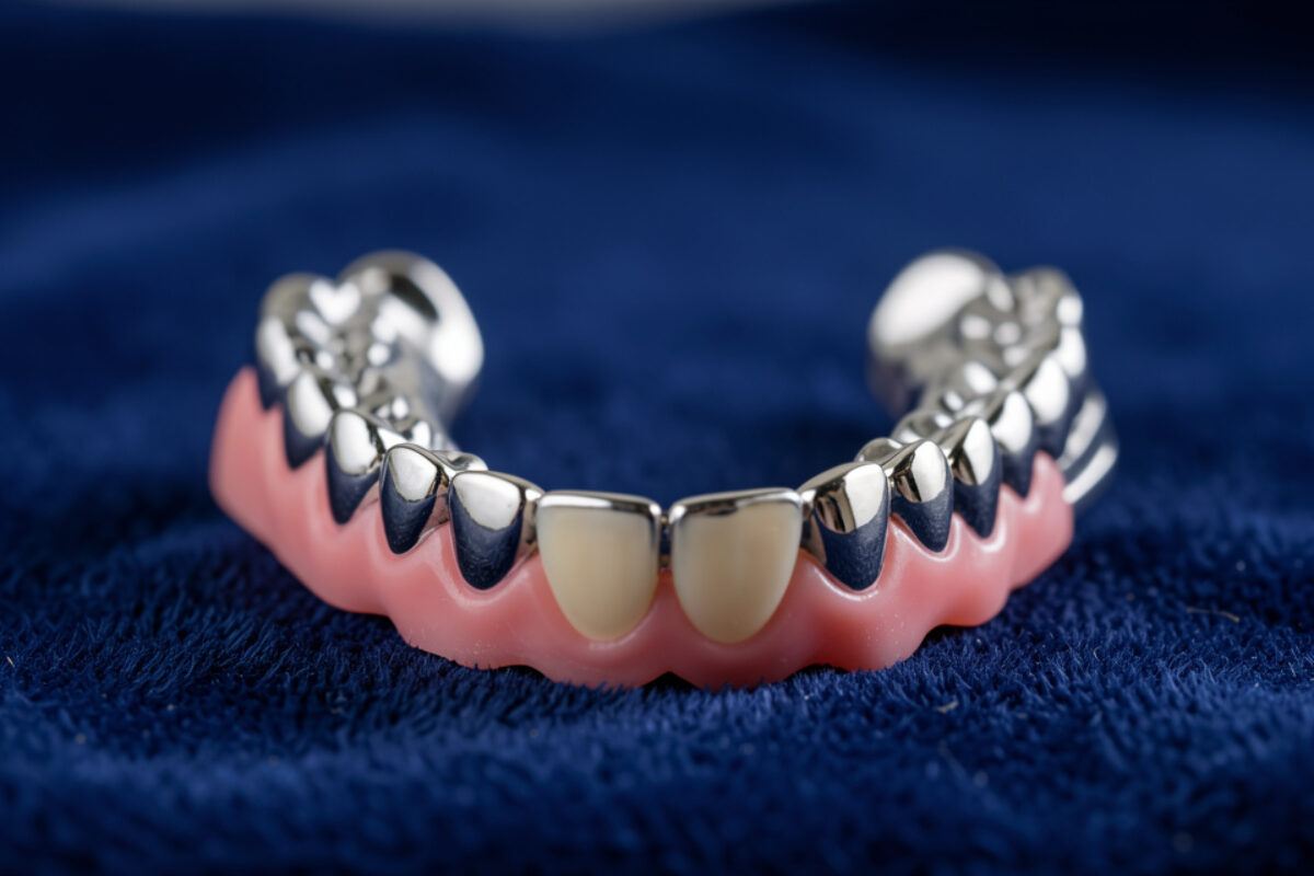 Stellite dentaire : guide complet sur la prothèse amovible partielle