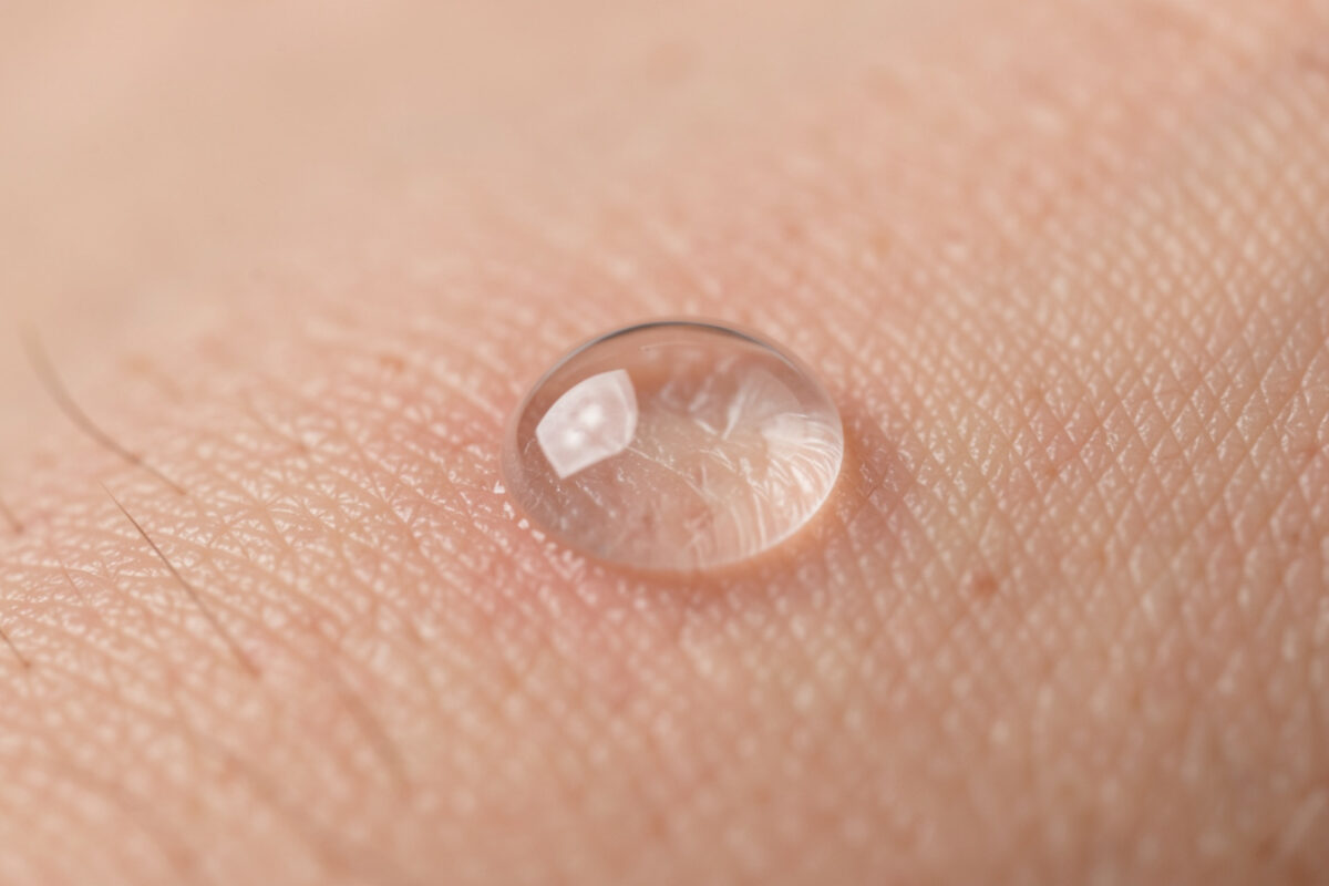 Verrue après cryothérapie : comprendre le gonflement normal