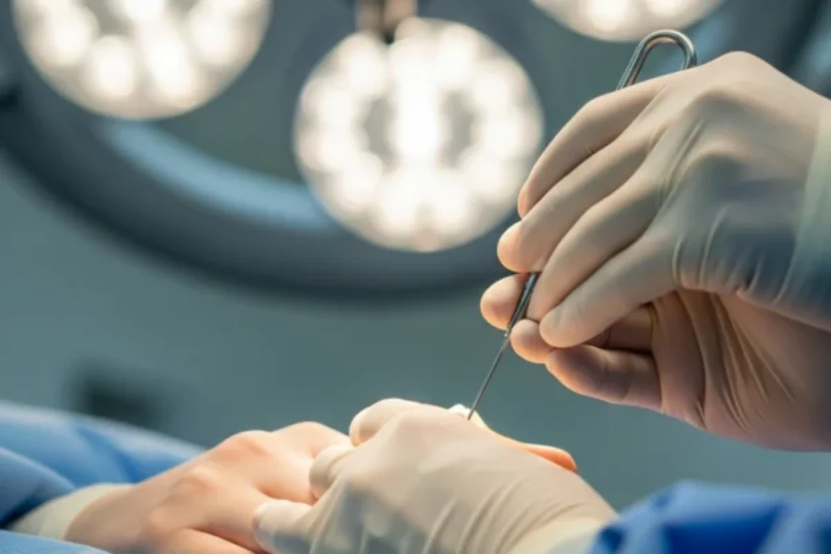 Broche percutanée : tout savoir sur cette technique osseuse