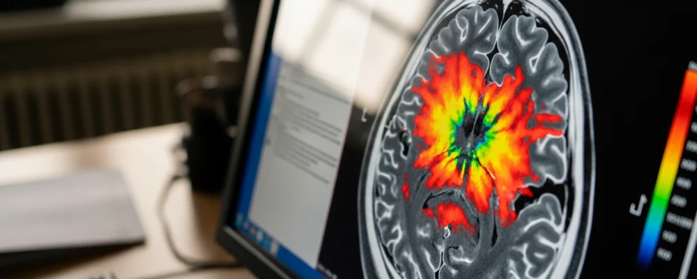Hypermétabolisme au PET scan : interprétation et signification clinique — hypermétabolique signification