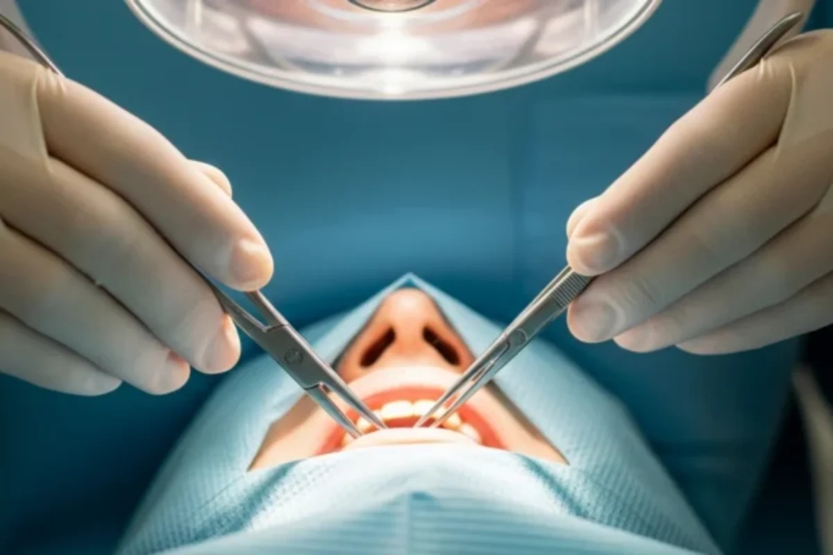 Opération dents de sagesse, anesthésie locale ou générale ?